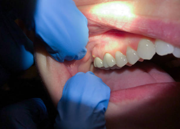 Best Emergency Root Canal Treatment in New Braunfels, TX